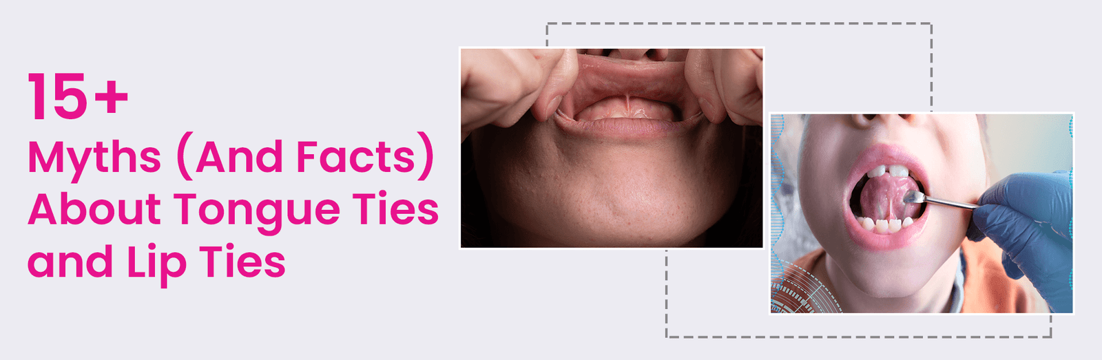 15+ Myths (And Facts) About Tongue Ties And Lip Ties