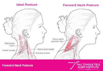 Are You Struggling With Headaches, Migraines And TMJ Disorder? | | TMJ, Tongue Tie & Sleep Institute – Tongue Tie Treatment in Mumbai, India | TMJ |