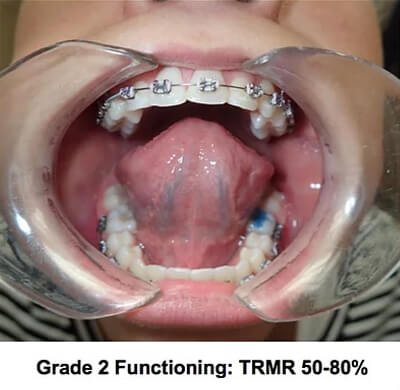 6 Steps Of Assessment: Do I Have A Tongue Tie? | | TMJ, Tongue Tie & Sleep Institute – Tongue Tie Treatment in Mumbai, India | Tongue Tie |