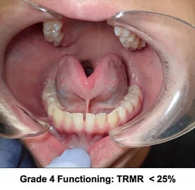 6 Steps Of Assessment: Do I Have A Tongue Tie? | | TMJ, Tongue Tie & Sleep Institute – Tongue Tie Treatment in Mumbai, India | Tongue Tie |