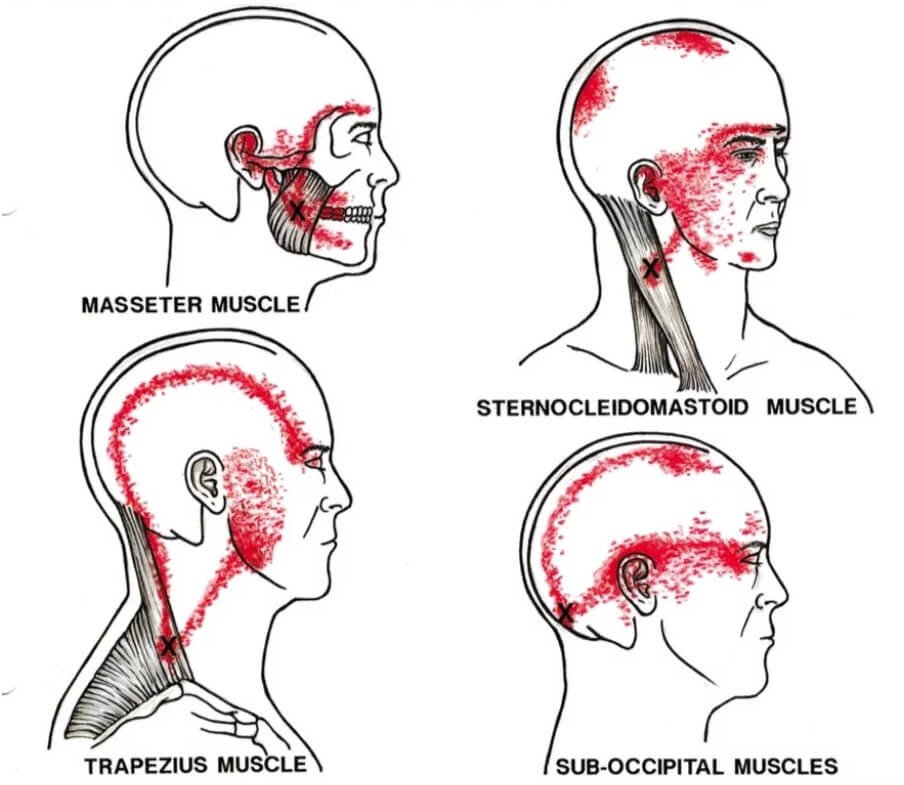 Tongue Tie Compensations: Fascial Restrictions, Tension And Pain | | TMJ, Tongue Tie & Sleep Institute – Tongue Tie Treatment in Mumbai, India | Tongue Tie |