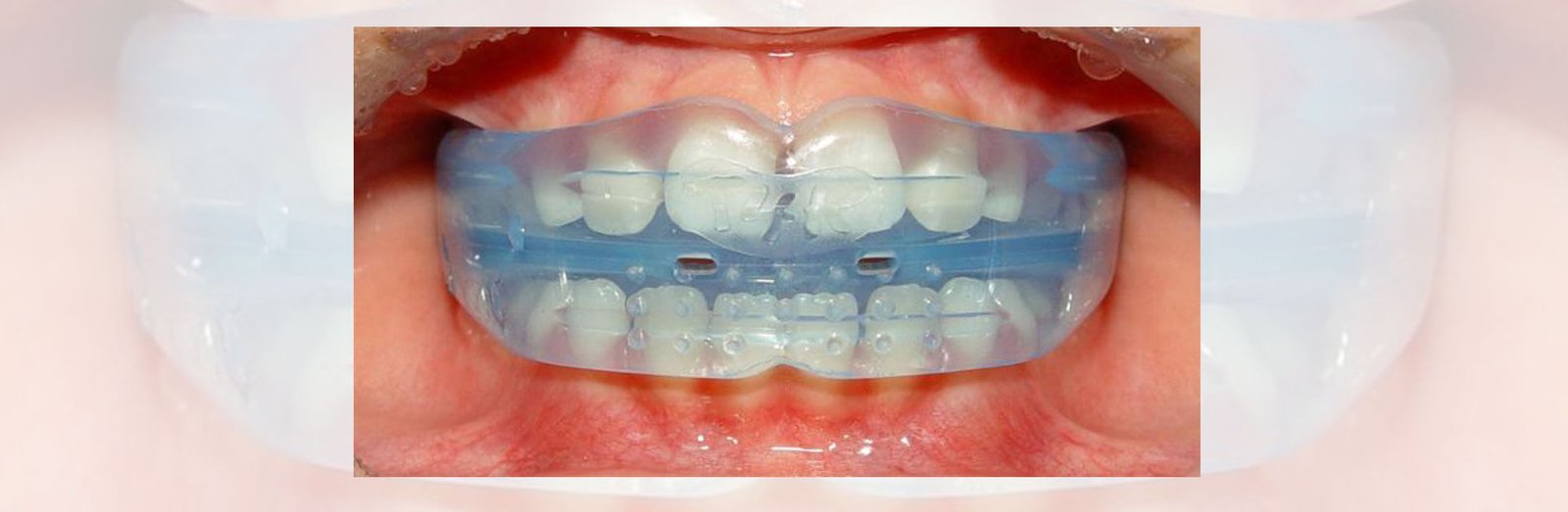 What Causes Crooked Teeth? How Soon Can You Correct Them?