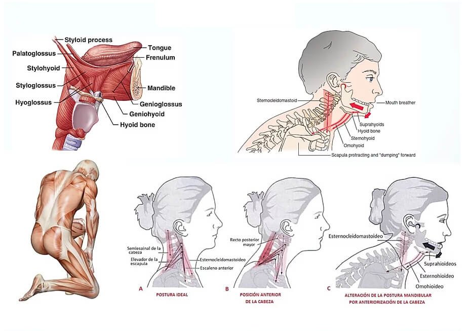 Tongue Tie Compensations: Fascial Restrictions, Tension And Pain | | TMJ, Tongue Tie & Sleep Institute – Tongue Tie Treatment in Mumbai, India | Tongue Tie |