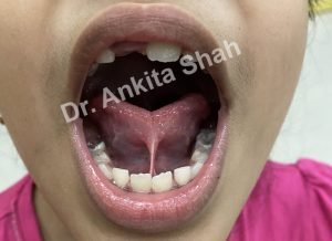What Exactly Is A Tongue Tie? How Does It Affect Us? | | TMJ, Tongue Tie & Sleep Institute – Tongue Tie Treatment in Mumbai, India What Exactly Is A Tongue Tie? How Does It Affect Us? | | TMJ, Tongue Tie & Sleep Institute – Tongue Tie Treatment in Mumbai, India | Tongue Tie |