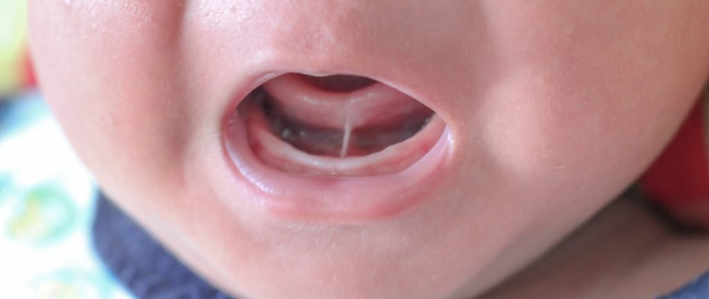 Infant | | TMJ, Tongue Tie & Sleep Institute – Tongue Tie Treatment in Mumbai, India | |