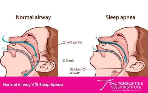 Tongue Tie & Sleep Apnea | | TMJ, Tongue Tie & Sleep Institute – Tongue Tie Treatment in Mumbai, India | |