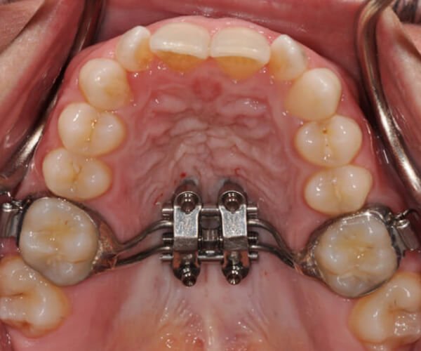 Why Is Airway Orthodontics Necessary To Align Your Teeth? | | TMJ, Tongue Tie & Sleep Institute – Tongue Tie Treatment in Mumbai, India | Myofunctional therapy |