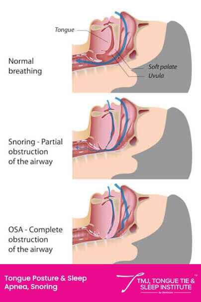 Tongue Tie & Sleep Apnea | | TMJ, Tongue Tie & Sleep Institute – Tongue Tie Treatment in Mumbai, India | |