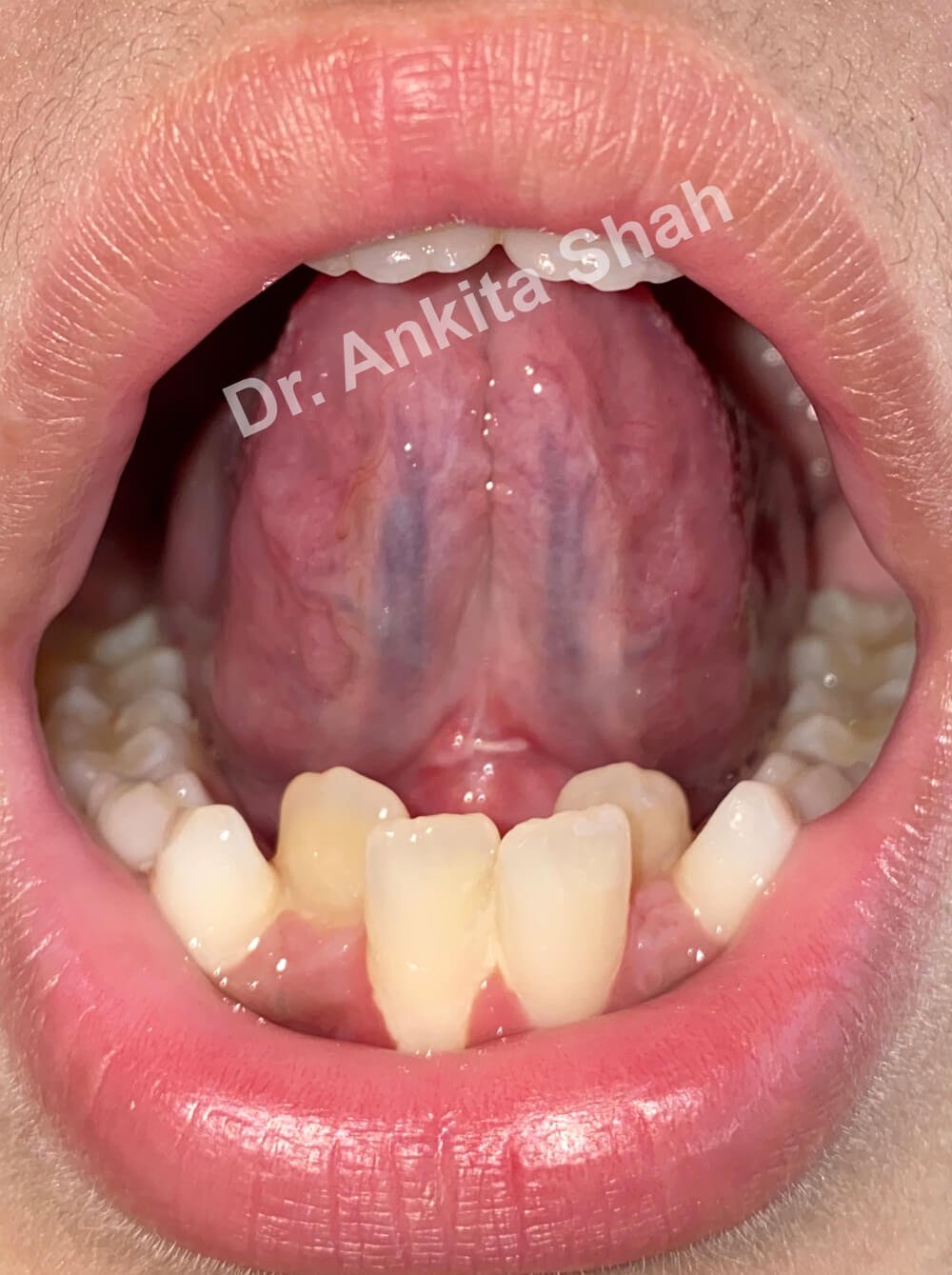 Dr Zaghis Functional Frenuloplasty | | TMJ, Tongue Tie & Sleep Institute – Tongue Tie Treatment in Mumbai, India | |