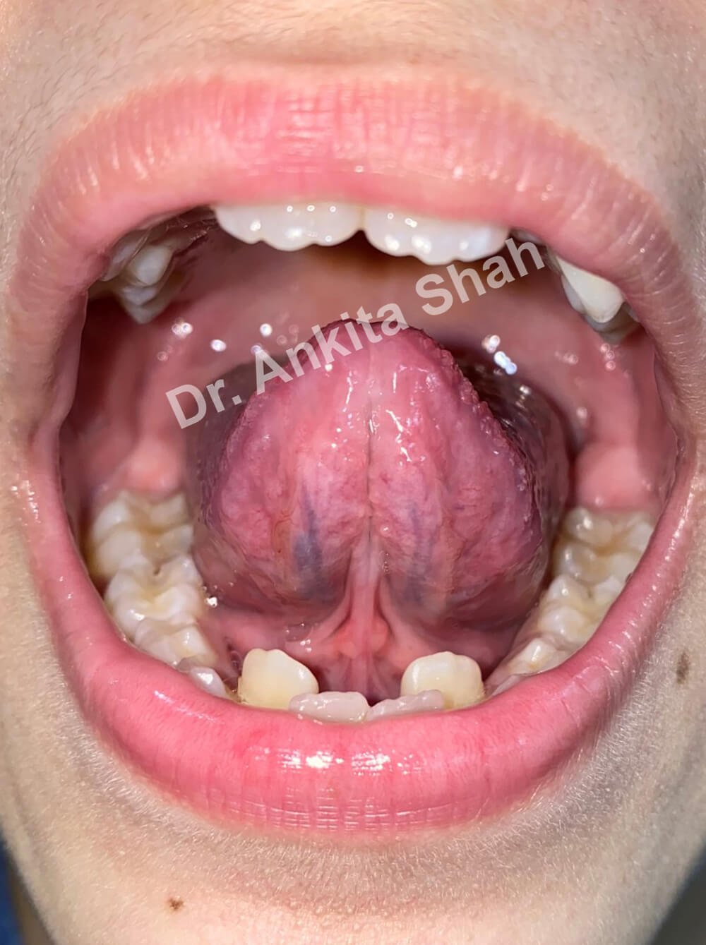 Dr Zaghis Functional Frenuloplasty | | TMJ, Tongue Tie & Sleep Institute – Tongue Tie Treatment in Mumbai, India | |