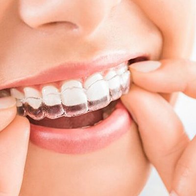 Things To Do Before And After Getting Braces | | TMJ, Tongue Tie & Sleep Institute – Tongue Tie Treatment in Mumbai, India | Myofunctional therapy |