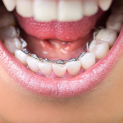 Things To Do Before And After Getting Braces | | TMJ, Tongue Tie & Sleep Institute – Tongue Tie Treatment in Mumbai, India | Myofunctional therapy |