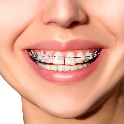 Things To Do Before And After Getting Braces | | TMJ, Tongue Tie & Sleep Institute – Tongue Tie Treatment in Mumbai, India | Myofunctional therapy |