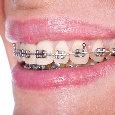 Things To Do Before And After Getting Braces | | TMJ, Tongue Tie & Sleep Institute – Tongue Tie Treatment in Mumbai, India | Myofunctional therapy |