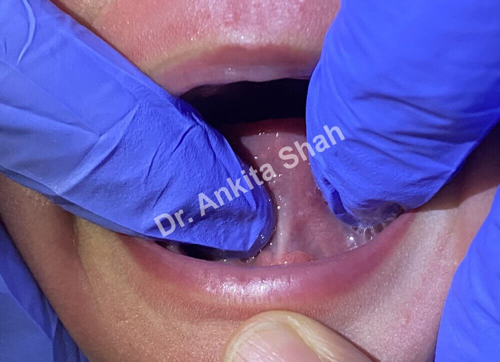 Tongue Tie Diagnosis: How To Determine Tongue Ties In Babies? | | TMJ, Tongue Tie & Sleep Institute – Tongue Tie Treatment in Mumbai, India | Tongue Tie |