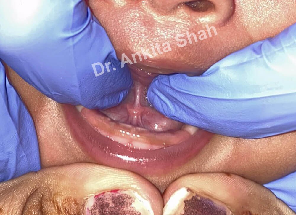 Tongue Tie Diagnosis: How To Determine Tongue Ties In Babies? | | TMJ, Tongue Tie & Sleep Institute – Tongue Tie Treatment in Mumbai, India | Tongue Tie |