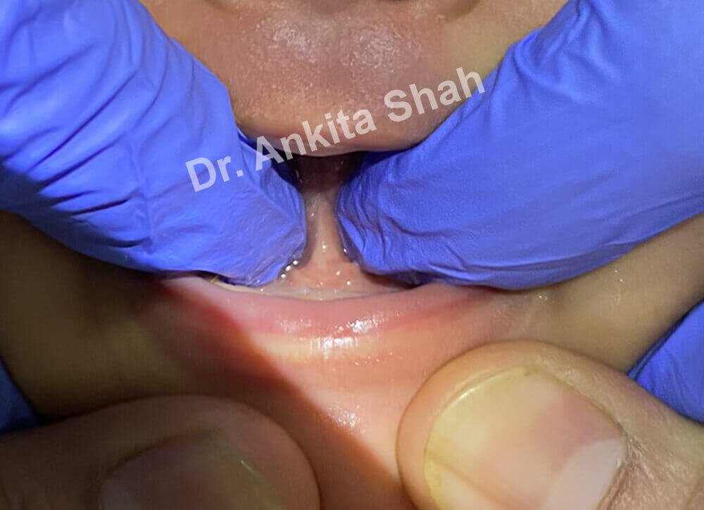 Tongue Tie Diagnosis: How To Determine Tongue Ties In Babies? | | TMJ, Tongue Tie & Sleep Institute – Tongue Tie Treatment in Mumbai, India | Tongue Tie |